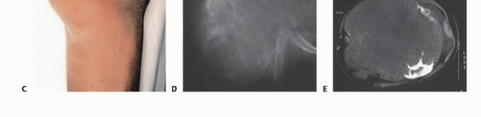 Illustration 11 for Mastering Above-Knee Amputation: Essential Surgical Insights