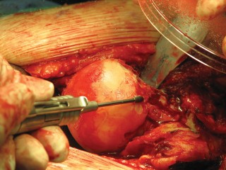 Illustration 32 for Figure Hip Resurfacing: Who Benefits and Who Should Avoid It?