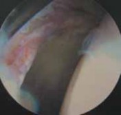 Illustration 12 for Resolving Femoral Head Neck Impingement: Arthroscopic FAI Solutions