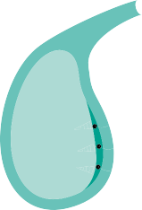 Illustration 17 for Mastering Surgery of the Undersurface of the Acromion