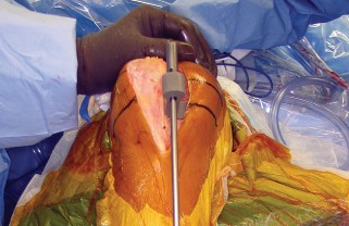 صورة طبية: استبدال مفصل الركبة بالحد الأدنى من التدخل الجراحي: ألم أقل وتعافٍ أسرع مع النهج شبه الرضفي الإنسي