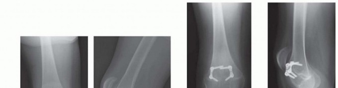 Illustration 7 for Optimizing Growth to Correct Pediatric Limb Deformities