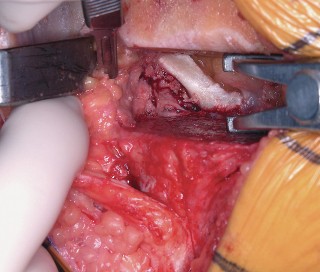 Illustration 41 for Mastering Valgus Total Knee Replacement: Techniques & Pitfalls