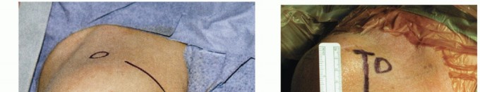 Illustration 12 for Bankart Repair & Inferior Capsular Shift: Solving Shoulder Instability