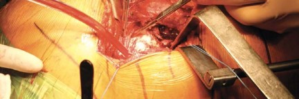 Illustration 13 for Metal on Metal Resurfacing: Enhanced Posterior Soft Tissue Repair