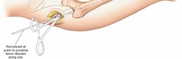 Illustration 73 for Optimal Femoral Approaches: Mastering the Lateral Intermuscular Septum