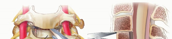 Illustration 31 for How ACDF Clears Your Posterior Disc Space for Lasting Relief