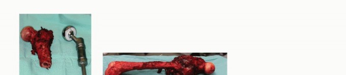 Illustration 36 for Beyond Amputation: Total Femur Resection with Endoprosthetics