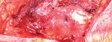 Illustration 13 for Mastering Direct Lateral Exposure for Revision Total Hip Success