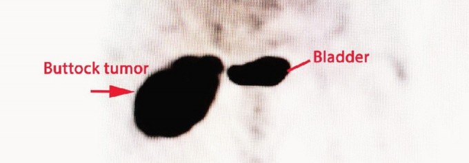 Illustration 6 for Beyond Hemipelvectomy: Preservation of the Sciatic in Buttock Surgery
