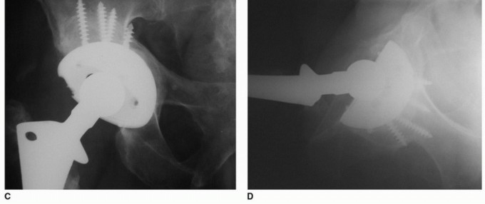 Illustration 9 for Osteolysis Solved: Polyethylene Liner Exchange for Well-Fixed Components