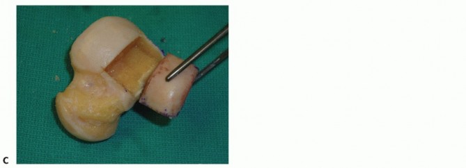 Illustration 15 for Unlock Healing: Medial Malleolar Osteotomy for Talus OLT Allografts