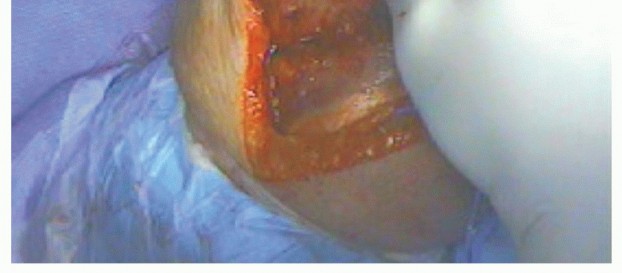 Elbow Arthroplasty for Primary Osteoarthritis: Restore Function