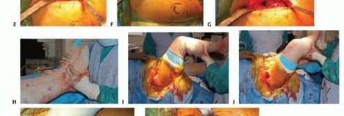 Illustration 19 for Hemiarthroplasty of the Hip: Indications & Types Explained
