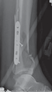 Illustration 28 for Optimizing ORIF for Tibial Plafond Fractures: A Modern Approach