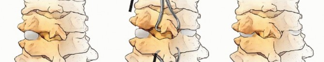 Illustration 37 for Master Techniques for Cervical Fracture Reduction: Type III & More