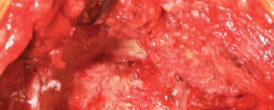 Illustration 5 for The Modified Hardinge Approach: Key Surgical Insights