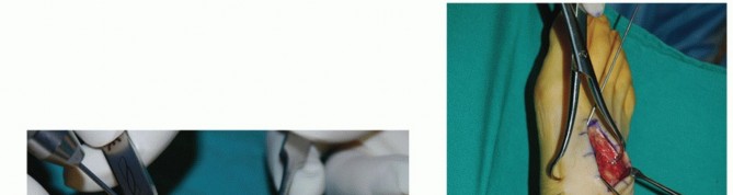 Illustration 12 for Mastering Midfoot Arthrodesis: Protect the Deep Neurovascular Bundle