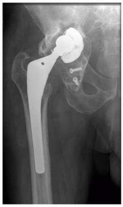 Illustration 3 for Mastering Revision THA: Strategies for Adverse Local Tissue Challenges