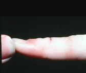 صورة طبية: دليل الأستاذ الدكتور محمد هطيف الشامل لأمراض وإصابات اليد والمعصم في صنعاء