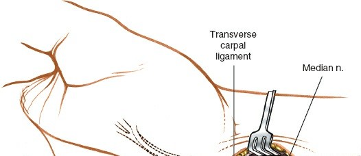 Illustration 17 for Volar Approach: Optimal Exposure for the Volar aspect of the Distal Radius