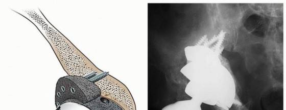 Illustration 4 for Uncemented Acetabular Component: Augments & Cup-Cages for Bone Loss