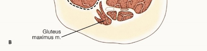 Illustration 16 for Limb-Sparing Quadriceps Resection: Superficial Femoral Artery