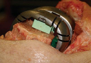Illustration 13 for Understand Augments: The Role of Metal Augments in Arthroplasty