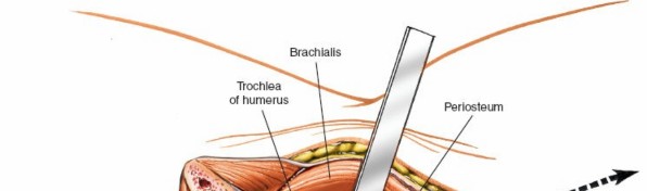 Illustration 40 for Mastering Elbow Approaches: Applied Surgical Anatomy for Precision