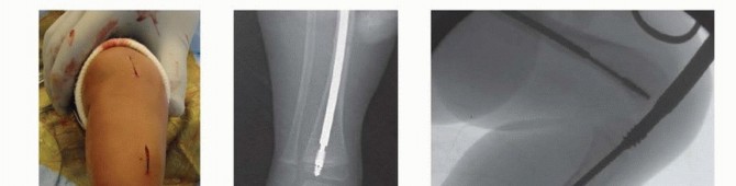 Illustration 28 for Less Pain, More Function: Fassier-Duval Nailing for Osteogenesis Imperfecta