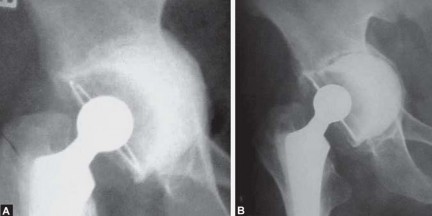 Illustration 21 for Total Hip Replacement for Protrusio: Restore Your Hip Function