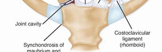Illustration 2 for Optimizing SC Dislocation Repair After Medial Clavicle Resection