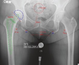 Illustration 5 for Primary Uncemented Total Hip Arthroplasty: A Case Study Title