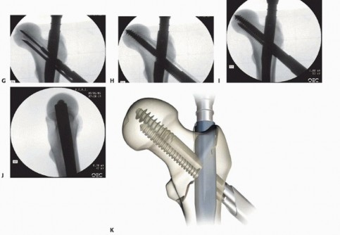 Illustration 31 for Achieve Optimal Femoral Head Fixation with Cephalomedullary Nailing