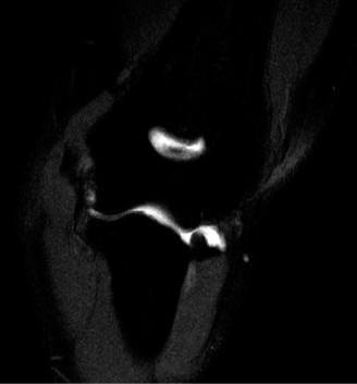 Illustration 4 for Solve Orthopedic Cases: Extensor Carpi Radialis Brevis & Elbow Pain