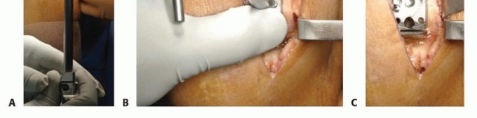 صورة طبية: استبدال مفصل الركبة الجزئي: حل متقدم لآلام الركبة المستمرة مع الأستاذ الدكتور محمد هطيف