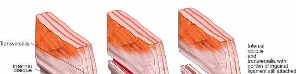 Illustration 16 for Ilioinguinal Approach: Master the Deep Inguinal Ring for Success