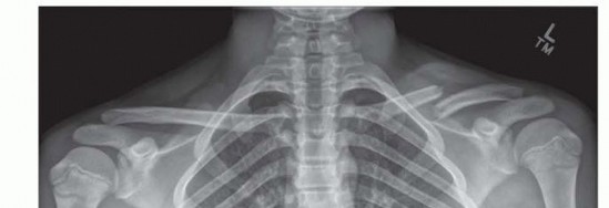 Optimal Open Reduction & Internal Fixation of Clavicular Fractures