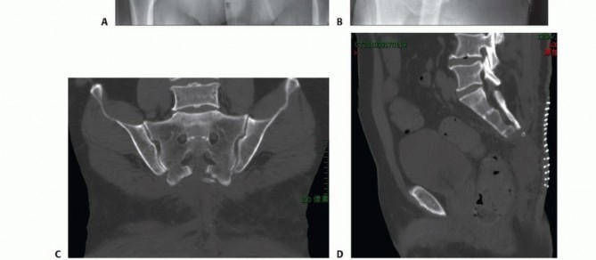 Illustration 58 for Sacral Tumor Surgery: Safeguarding Bowel & Bladder Control