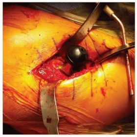 Illustration 16 for The Tapered Stem: Your Guide to Durable Cementless Hip Fixation