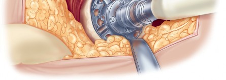 Illustration 59 for Direct Lateral Hip: Optimize Exposure with Sharp Curved Hohmann