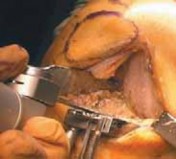 Illustration 10 for Knee Arthroplasty Unicondylar: Discover if Partial Knee Replacement is Right