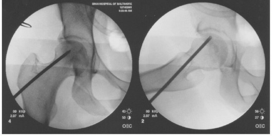 Illustration 4 for Head-Sparing for Osteonecrosis of the Femoral: Preserve Your Hip