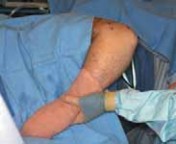 Arthroscopic Débridement: Solving Elbow Degenerative Joint Disease Pain