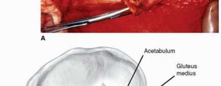 Illustration 9 for Recreate Hip Biomechanics: Modular Stems for Modular Solutions
