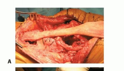 Illustration 11 for Patella Tendon Rupture Reconstruction in Revision TKA