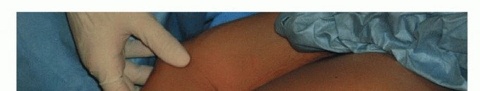 Illustration 14 for Is Your Dorsal Scapular Nerve Causing Snapping Scapula Pain?