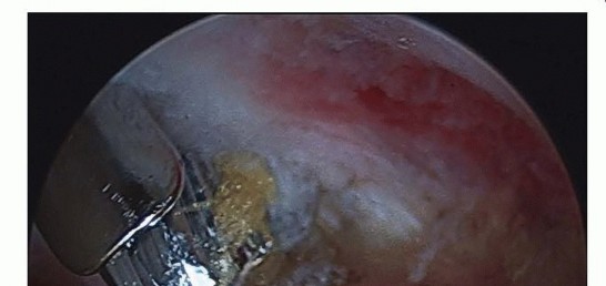 Illustration 30 for Hip Arthroscopy: Your Minimally Invasive Solution for Hip Pain