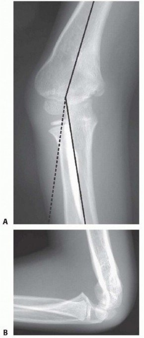 Illustration of supracondylar humeral osteotomy - Dr. Mohammed Hutaif