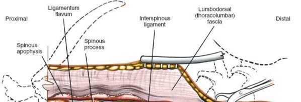 Illustration 358 for Approach to the Lumbar Spine: Mastering Techniques & Anatomy